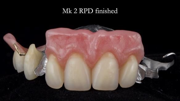 Newsletter 71 Jean’s Class I Mod III RPD: See my mistakes Fractured Mk1 to a Stronger Mk2 RPD (4 years on)