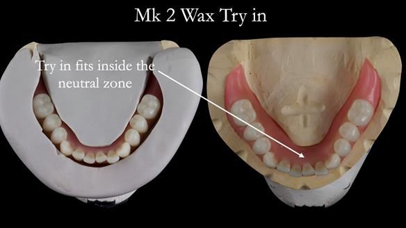 Replacing Madeline’s Complete denture FULL PROTOCOL