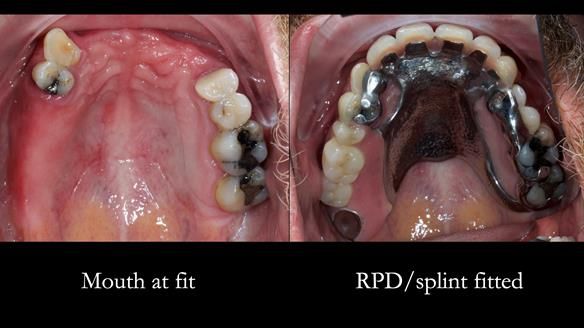 How Keith’s combat denture transformed his life – Newsletter 73