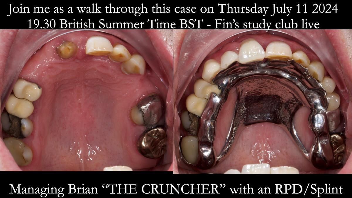 Read Newsletter 67 - Brian's COMBAT DENTURE Case Study