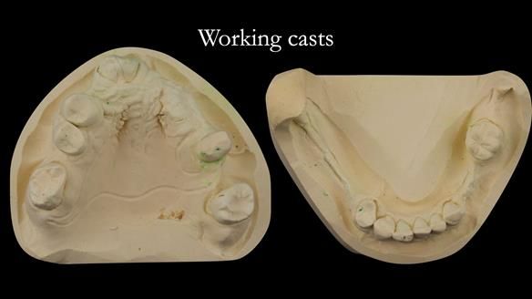 Eileen's transformation with upper and lower RPDs of Scandinavian hygienic design FULL PROTOCOL