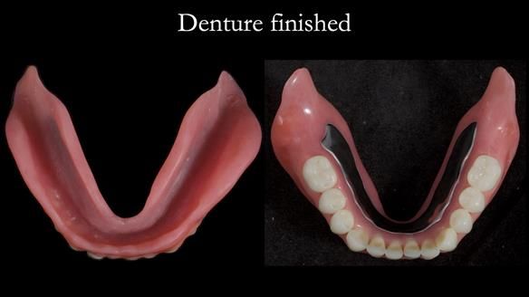 Newsletter 70 Complete Denture Treatment for Kate: A Case Study on Natural-Looking Dentures and Implant-Supported Overdentures