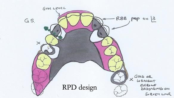 Managing Edgar “THE SCEPTIC” with an RPD/Splint FULL CASE