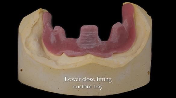 Newsletter 74: Ken’s Case Study Complete Dentures - Life Like and Age Appropriate