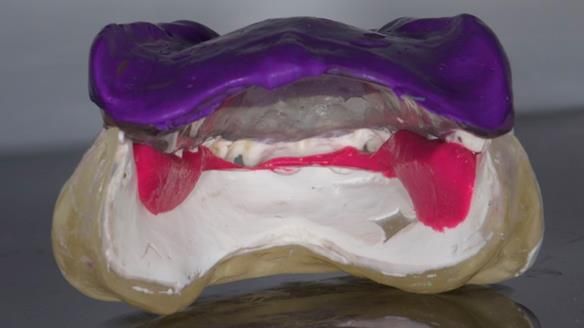 Replacing Madeline’s Complete denture FULL PROTOCOL