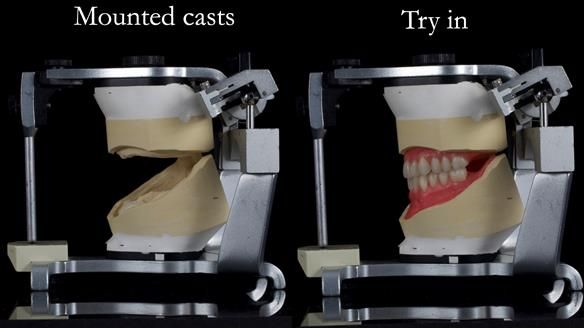 Newsletter 68 Restoring Jan’s Smile: Complete Dentures Inspired by Her Daughter’s Teeth - Post Mouth Surgery