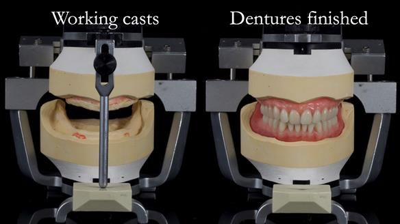 Newsletter 70 Complete Denture Treatment for Kate: A Case Study on Natural-Looking Dentures and Implant-Supported Overdentures