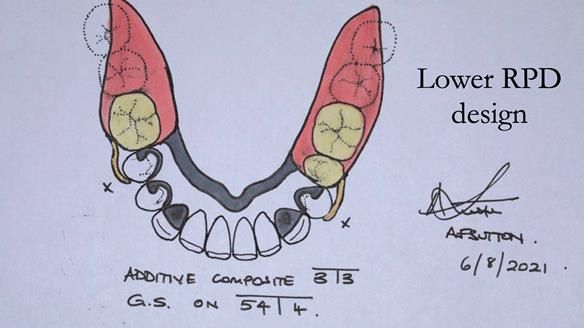 Solving Linda’s Failed “All on 4” implant bridges - full protocol Newsletter 42