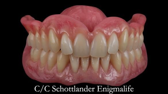 Newsletter 48 Mavis's Complete denture FULL PROTOCOL