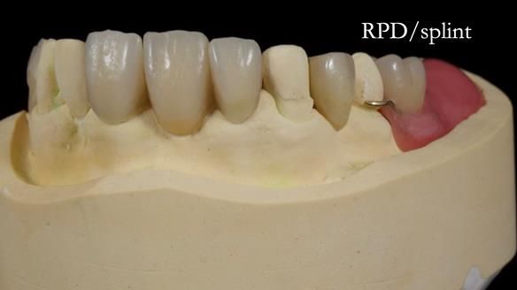 Managing Edgar “THE SCEPTIC” with an RPD/Splint FULL CASE