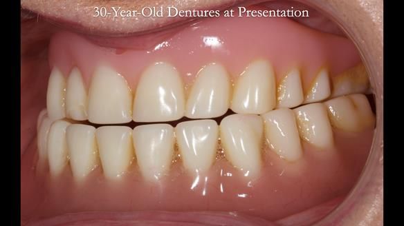 Newsletter 68 Restoring Jan’s Smile: Complete Dentures Inspired by Her Daughter’s Teeth - Post Mouth Surgery