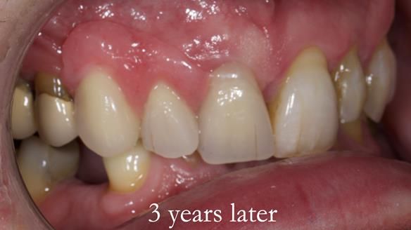 Read Newsletter 67 - Brian's COMBAT DENTURE Case Study