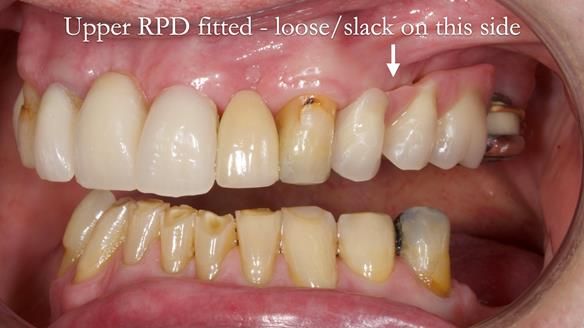 Managing Edgar “THE SCEPTIC” with an RPD/Splint FULL CASE