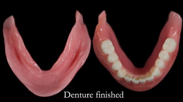 Newsletter 68 Restoring Jan’s Smile: Complete Dentures Inspired by Her Daughter’s Teeth - Post Mouth Surgery