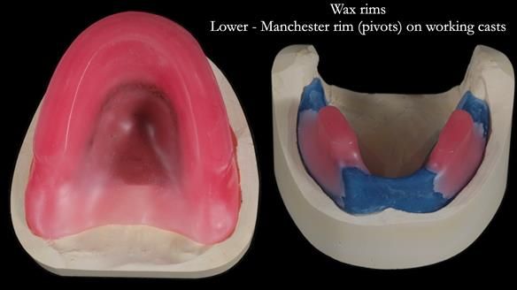 Newsletter 65 Marisa Provision of Complete Dentures on badly placed implants