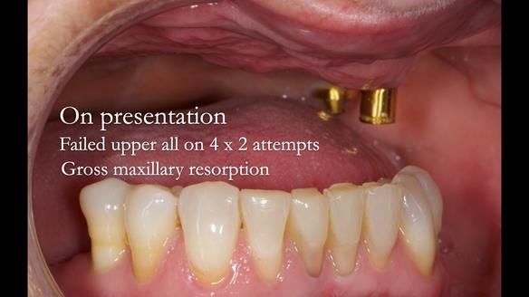 Solving Linda’s Failed “All on 4” implant bridges - full protocol Newsletter 42