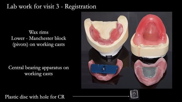 Newsletter 74: Ken’s Case Study Complete Dentures - Life Like and Age Appropriate