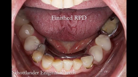 Eileen's transformation with upper and lower RPDs of Scandinavian hygienic design FULL PROTOCOL