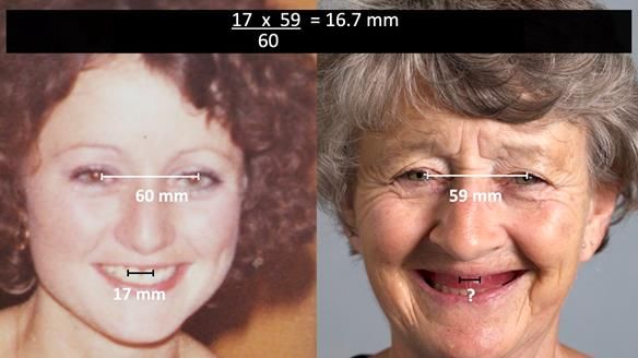 Solving Linda’s Failed “All on 4” implant bridges - full protocol Newsletter 42