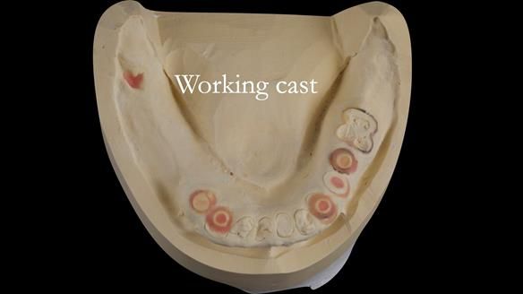 Newsletter 44 - extreme removable prosthodontics – engineering a super-strong and ultra-thin over denture