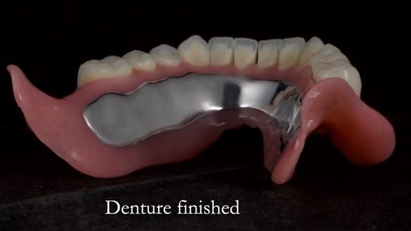 Newsletter 70 Complete Denture Treatment for Kate: A Case Study on Natural-Looking Dentures and Implant-Supported Overdentures