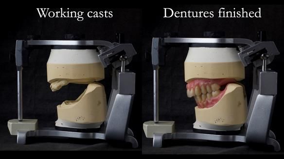 Newsletter 74: Ken’s Case Study Complete Dentures - Life Like and Age Appropriate