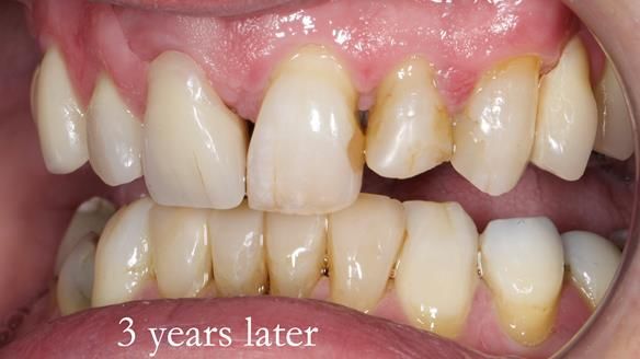 Read Newsletter 67 - Brian's COMBAT DENTURE Case Study