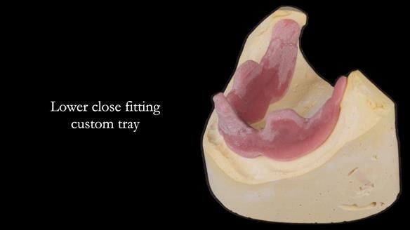 Newsletter 74: Ken’s Case Study Complete Dentures - Life Like and Age Appropriate