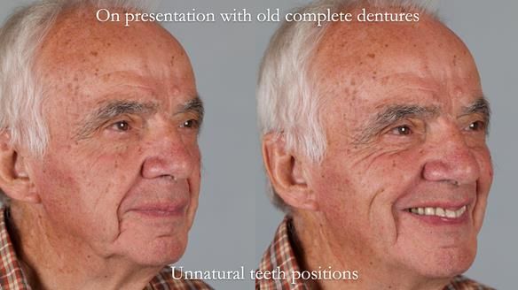 Newsletter 74: Ken’s Case Study Complete Dentures - Life Like and Age Appropriate