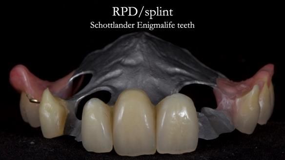 Managing Edgar “THE SCEPTIC” with an RPD/Splint FULL CASE