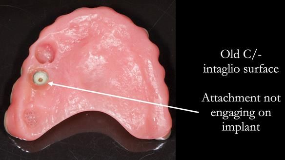 Solving Linda’s Failed “All on 4” implant bridges - full protocol Newsletter 42