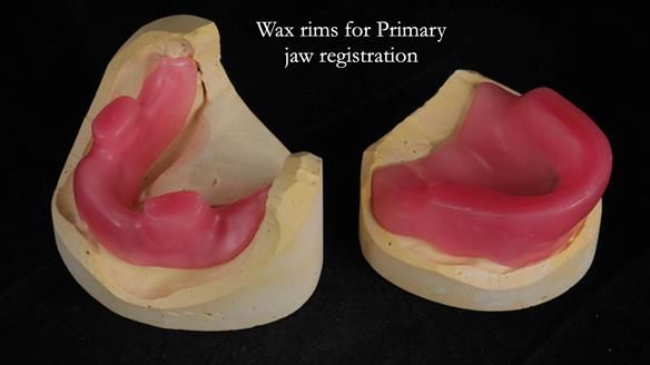 Newsletter 65 Marisa Provision of Complete Dentures on badly placed implants