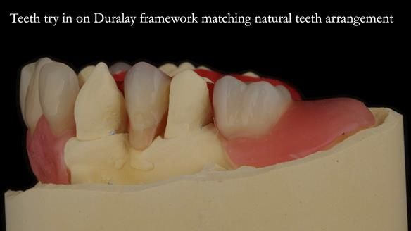 Newsletter 71 Jean’s Class I Mod III RPD: See my mistakes Fractured Mk1 to a Stronger Mk2 RPD (4 years on)