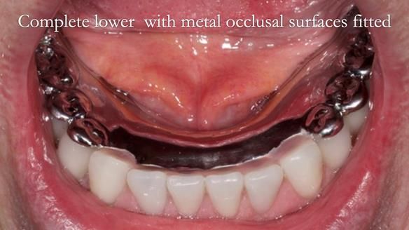 Newsletter 44 - extreme removable prosthodontics – engineering a super-strong and ultra-thin over denture