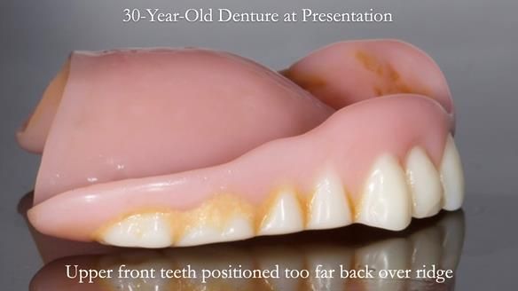 Newsletter 68 Restoring Jan’s Smile: Complete Dentures Inspired by Her Daughter’s Teeth - Post Mouth Surgery