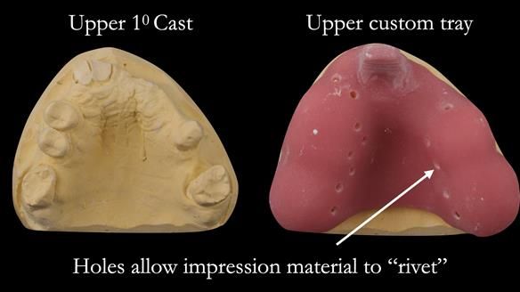 Eileen's transformation with upper and lower RPDs of Scandinavian hygienic design FULL PROTOCOL