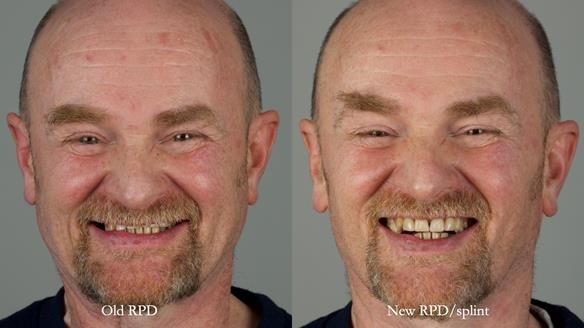 How Keith’s combat denture transformed his life – Newsletter 73