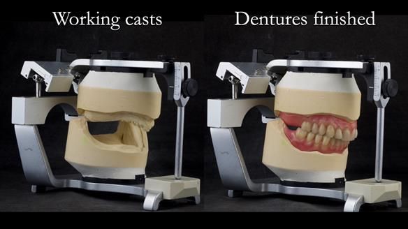 Newsletter 74: Ken’s Case Study Complete Dentures - Life Like and Age Appropriate