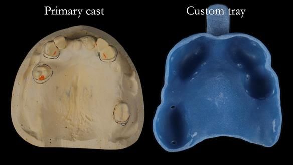 Managing Edgar “THE SCEPTIC” with an RPD/Splint FULL CASE