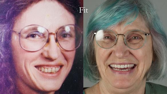 Newsletter 70 Complete Denture Treatment for Kate: A Case Study on Natural-Looking Dentures and Implant-Supported Overdentures