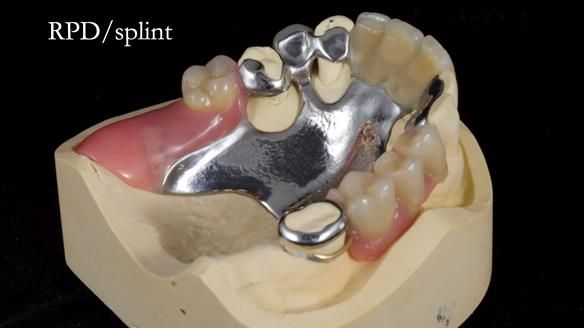 Managing Edgar “THE SCEPTIC” with an RPD/Splint FULL CASE