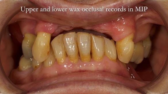 Newsletter 71 Jean’s Class I Mod III RPD: See my mistakes Fractured Mk1 to a Stronger Mk2 RPD (4 years on)