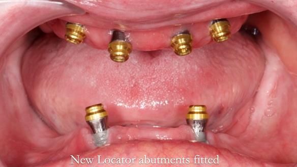 Newsletter 65 Marisa Provision of Complete Dentures on badly placed implants