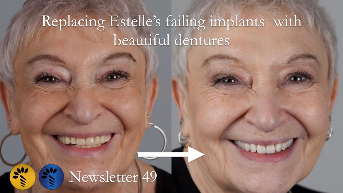 Full protocol - provision of a complete upper denture and lower implant supported metal based complete denture for Estelle, after implant failure.