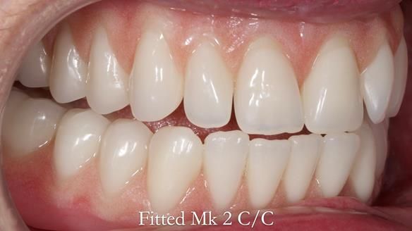 Replacing Madeline’s Complete denture FULL PROTOCOL