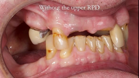 Managing Edgar “THE SCEPTIC” with an RPD/Splint FULL CASE