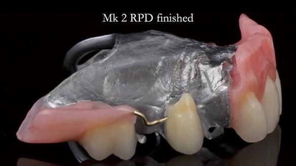 Newsletter 71 Jean’s Class I Mod III RPD: See my mistakes Fractured Mk1 to a Stronger Mk2 RPD (4 years on)