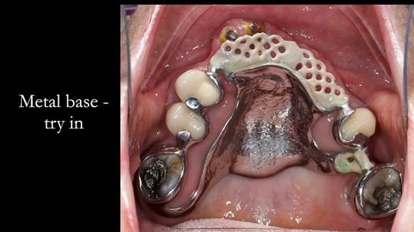 Eileen's transformation with upper and lower RPDs of Scandinavian hygienic design FULL PROTOCOL