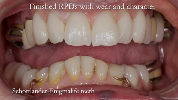 Eileen's transformation with upper and lower RPDs of Scandinavian hygienic design FULL PROTOCOL