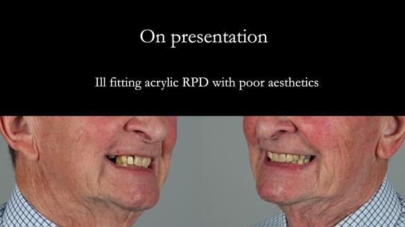 Managing Edgar “THE SCEPTIC” with an RPD/Splint FULL CASE